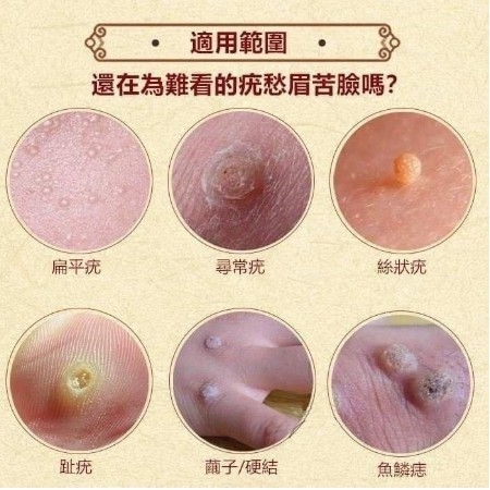 日本 面部扁平去疣膏10g