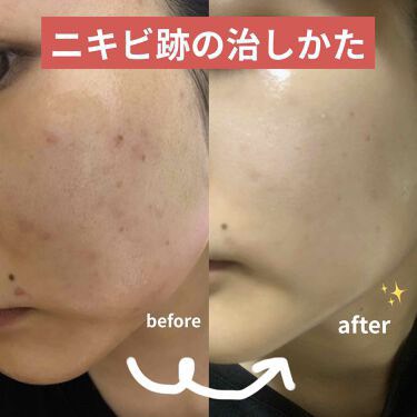 日本🇯🇵小林製藥痘痘護理凝膠 10g