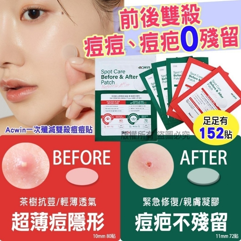 韓國Acwin一次殲滅雙殺痘痘貼152貼